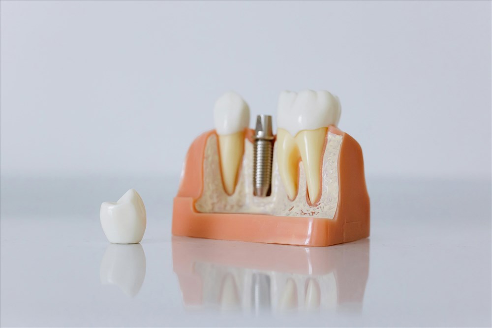 Bridge Complet sur Implant : Tout Ce Qu'il Faut Savoir