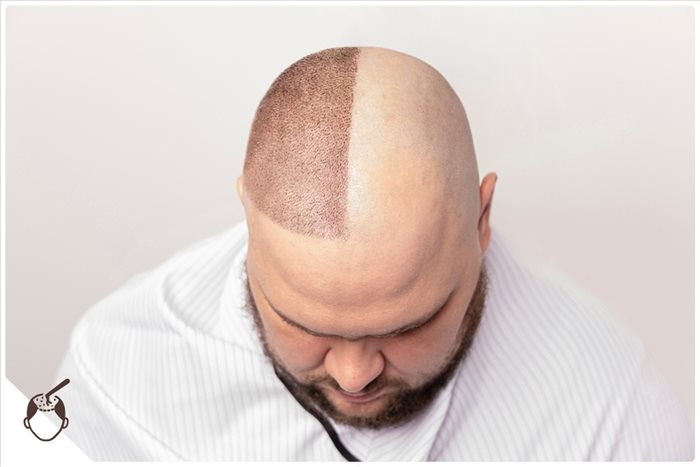 Greffe de cheveux à Nice : comment trouver un spécialiste ?