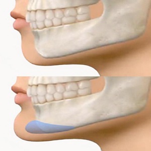 Opération maxillo faciale en Turquie, un praticien en chirurgie plastique à Paris 11ème